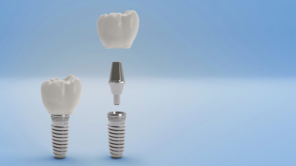 Dental Implants in Southern OK