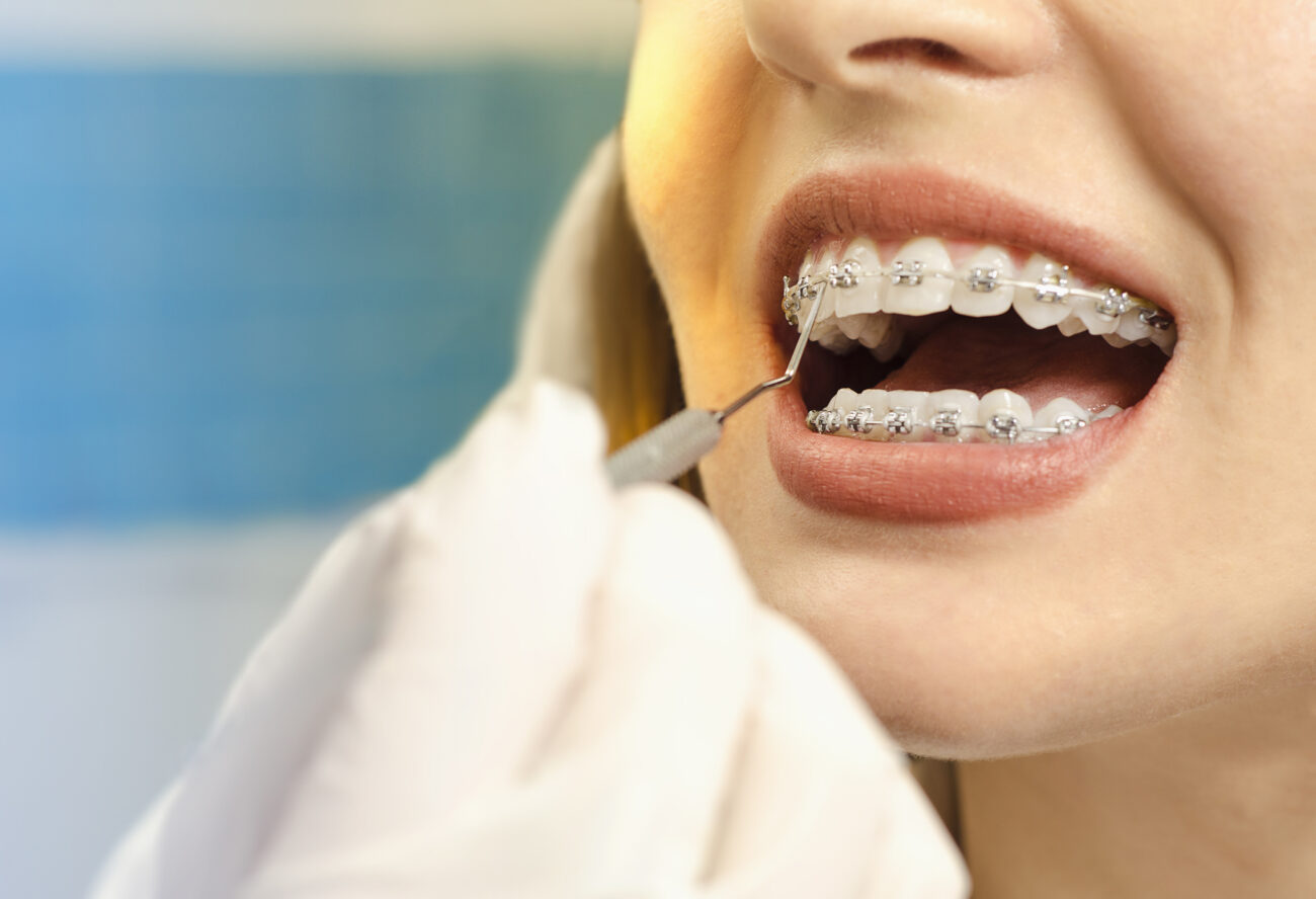 Orthodontic Services at Storts Family Dentistry