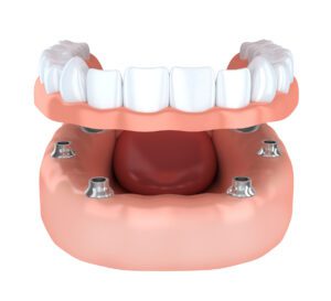 implant-secured dentures in Southern Oklahoma
